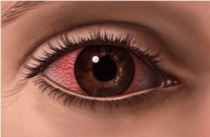 Produce algún a la salud visual lentillas por largos periodos - Color de Ojos